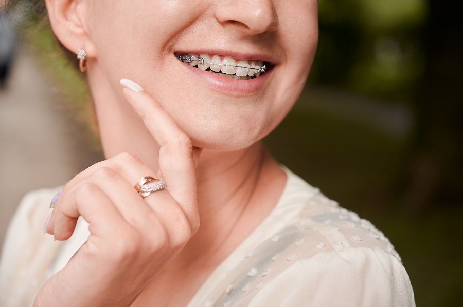 How To Care For Your Dental Braces During Orthodontic Treatments